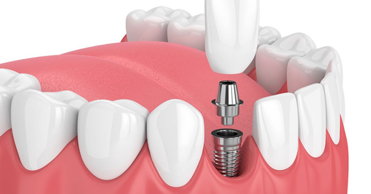 How Long After Dental Implants Can I Eat Normally