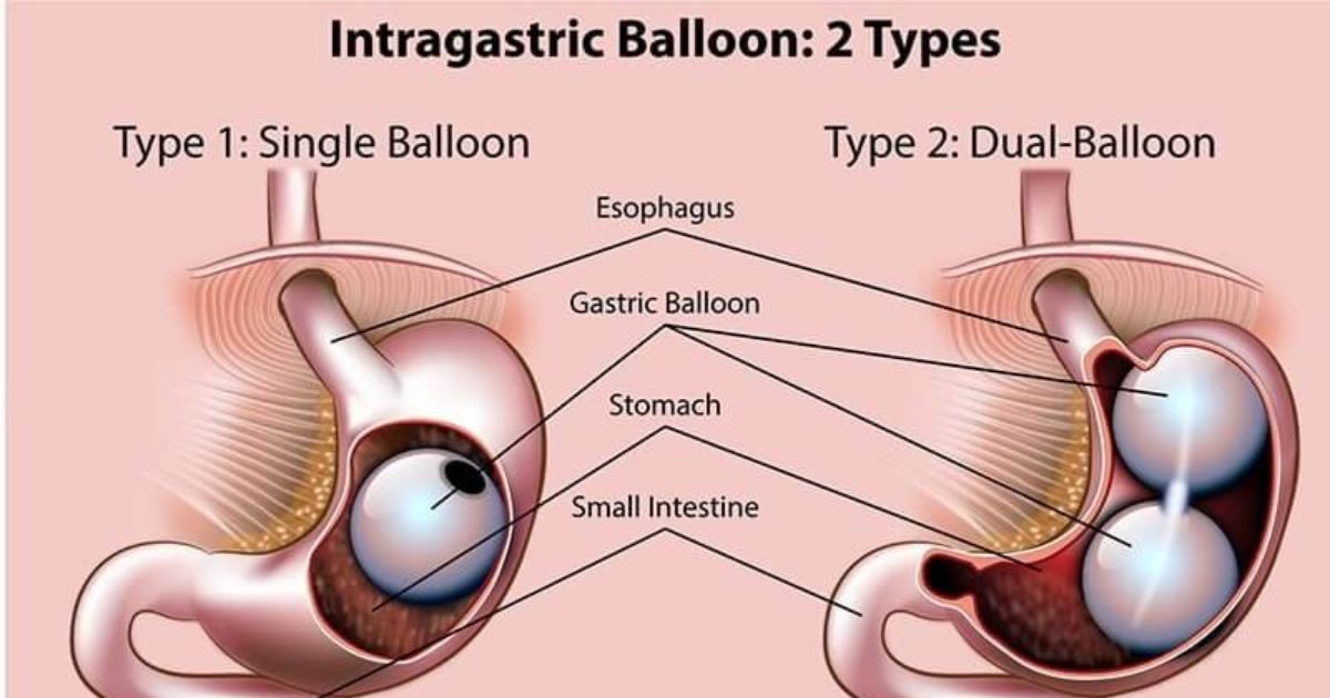 Does Health Insurance Cover Gastric Balloons?