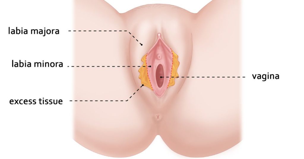 What are the medical reasons for labiaplasty